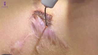 درمانهای قابل انجام با پلکسرپلاس فرکشنال