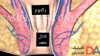 بواسیر چیست؟ - درمان تهران