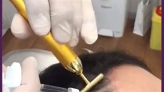 هزینه و مزایای استفاده از فیلر مو