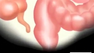 شقاق مقعدی چیست؟ چگونه به وجود می اید؟ - درمان تهران