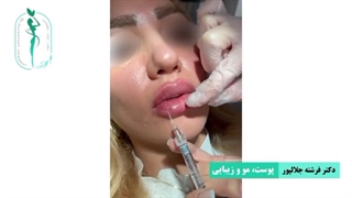 تزریق یک سی سی ژل لب با متد روسی | دکتر فرشته جلالپور