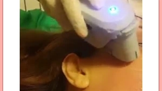 هایفوتراپی معجزه جوانسازی و لیفت صورت /هزینه و مزایا پر کردن دندان