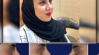 رضایت بیمار عزیز یک ماه و نیم پس از عمل بینی گوشتی | دکتر گلی