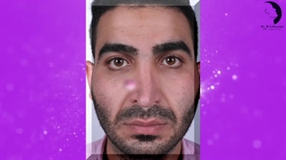 جراحی بینی ترمیمی مردانه در اهواز | دکتر محمدعلی حسینی زیبایی پوست