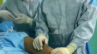 بازسازی pcl acl با الوگرافت به روش ارتروسکوپیک