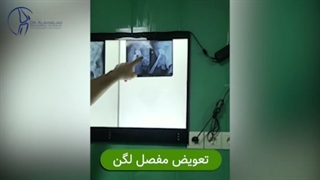 تعویض مفصل لگن