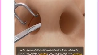 قیمت، مزایا و عوارض احتمالی رینوپلاستی