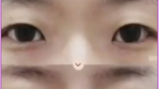 کانتوپلاستی (Canthoplasty) یا عمل چشم گربه ای چیست ؟