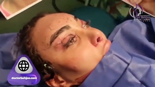 لیفت ابرو و شقیقه به روش اندوسکوپی