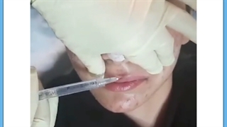 راهکار قطعی از بین بردن خط خنده با تزریق ژل پیلینگ شیمیایی
