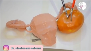 جراحی برداشتن کیست تخمدان