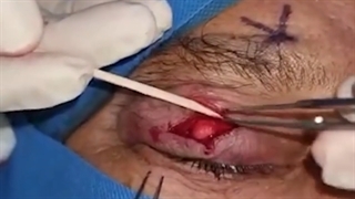 برداشتن توده تومورال پلک فوقانی