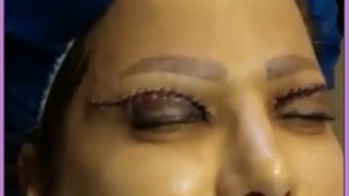 هزینه جراحی پلک چقدر است ؟