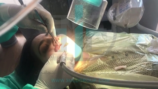 مکنده آلاینده های دندانپزشکی Fume Eliminator
