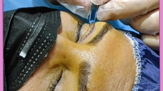 عوارض جراحی پلک جراحی بینی