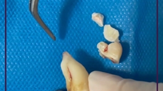 مشکلات دندان چماقی