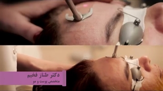 لیزر سایتون برای شفاف سازی و رفع چین و چروک