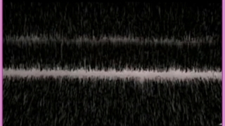 کاشت مو به روش BHT