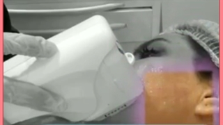 مراقبت های بعد ازهایفوتراپی دندانپزشک زیبایی