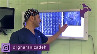درد مفصل به علت تومور | دکتر کاوه قرنی زاده تزریق ژل