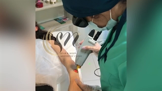 لیزر مو پر قدرت الکس کندلا ( کلینیک زیبایی استار بیوتی )