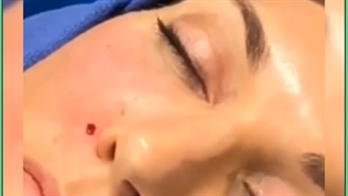 تزریق چربی در بهترین مرکز پوست و مو تهران