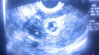 نتیجه IVF موفق