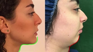 این همه تغییر با جراحی چانه باورنکردنیه!!!