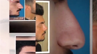 فرم بینی طبیعی