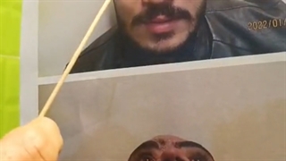 فیلم بدون سانسور بازسازی بینی با کمک غضروف دنده