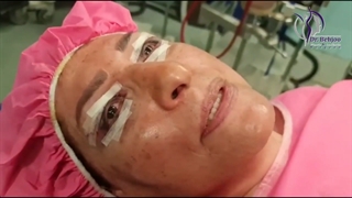 آواز به وقت جراحی پلک