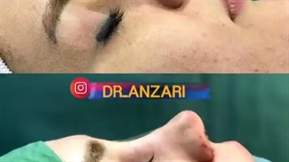 فیلم کامل و بدون سانسور از اتاق عمل جراحی بینی