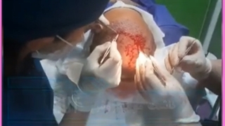 مراحل، مزایا و هزینه کاشت مو به روش SUPER FUE