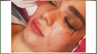 هزینه،روش ها و مزایای لیفت چشم بدون جراحی عمل زیبایی