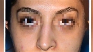 نمونه جراحی بینی دکتر ریحانه حیدری