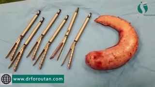 جراحی اسلیو معده در خانمی جوان