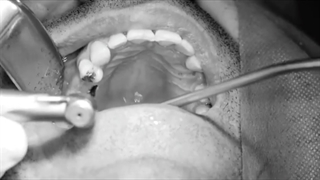 دکتر وحید دهقان: کاشت ایمپلنت