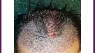 آشنایی با جدیدترین و مدرن ترین روش های کاشت مو در ایران