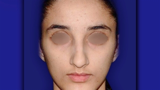 قبل و بعد جراحی رینوپلاستی | دکتر خوروش