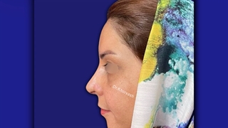 دو ماه بعد از جراحی بینی و لیفت آندوسکوپی ابروها | دکتر خوروش