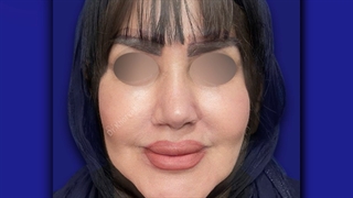 یک ماه بعد از جراحی زیبایی بینی | دکتر خوروش