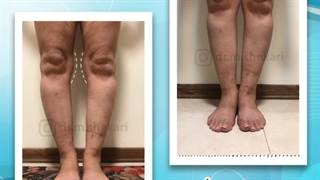 درمان بدون جراحی انحراف زانو