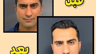 قبل و بعد کاشت مو در کلینیک ترانسپلنت