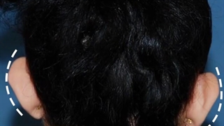 جراحی زیبایی گوش ( اتوپلاستی ) | دکتر شاهرخ خوش سیرت