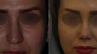 قبل و بعد از جراحی بینی زیباجوی عزیزمون