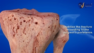 تکنیک جراحی ارتوپدی