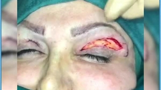 هزینه جراحی پلک چقدر است؟ پلاستیک لثه