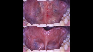 جراحی فرنکتومی با لیزر راه درمان مشکلات تکلمی | سیمادنت