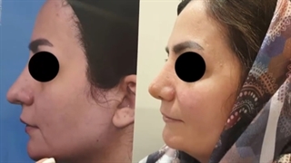 نمونه جراحی زیبایی بینی