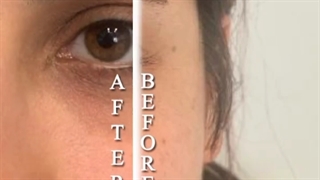 تزریق فیلر زیر چشم